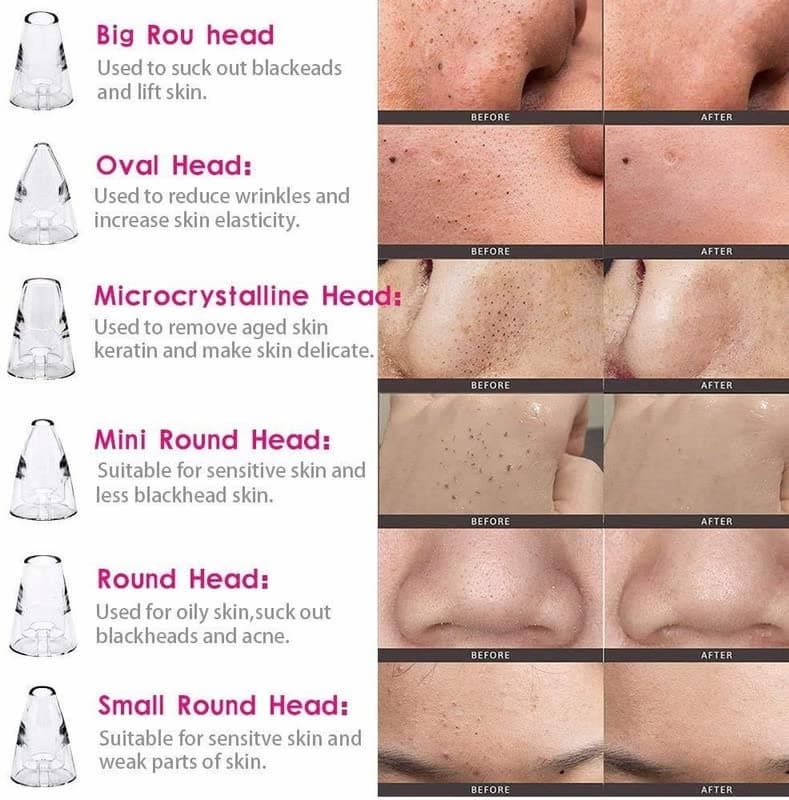 ⭐ DermaGlow™ 5-in-1 Acne & Blackhead Remover Pro