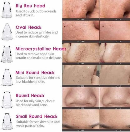 ⭐ DermaGlow™ 5-in-1 Acne & Blackhead Remover Pro